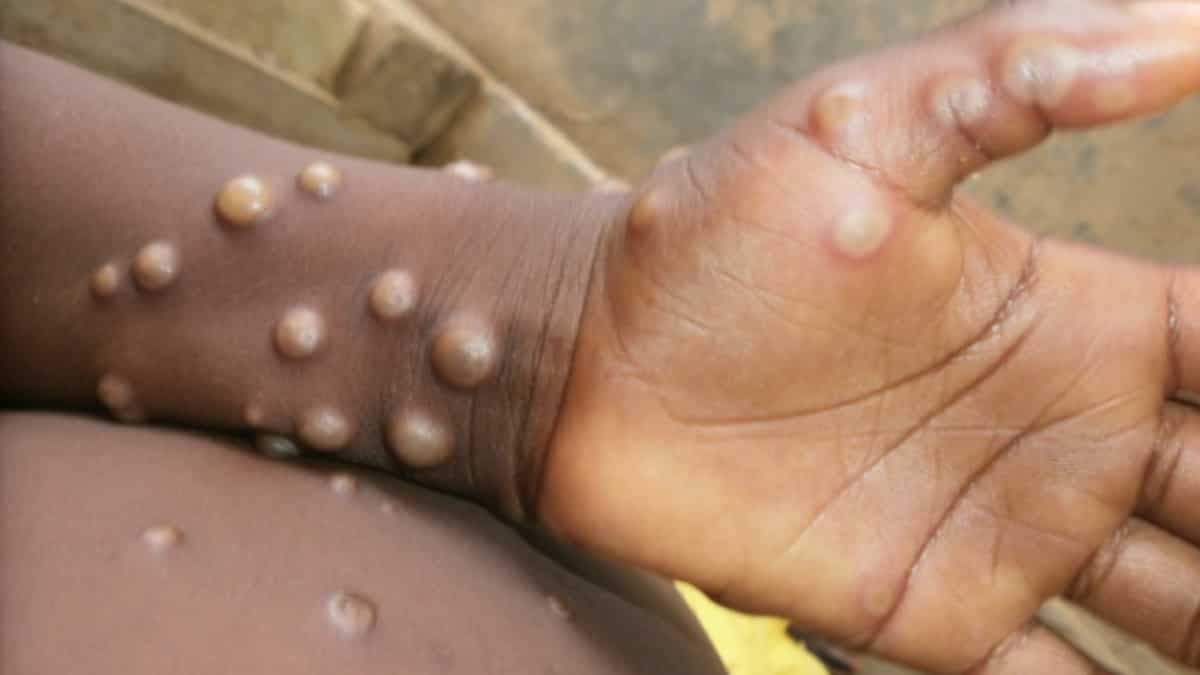 India’s mpox update: India safe, no unique cases since March; high-level assembly finds ‘low outbreak probability’